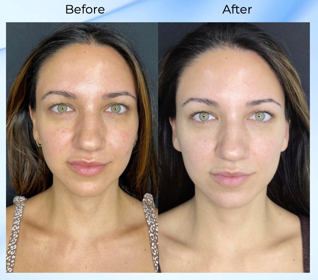 Hyperpigmentation Treatment in North Miami, FL